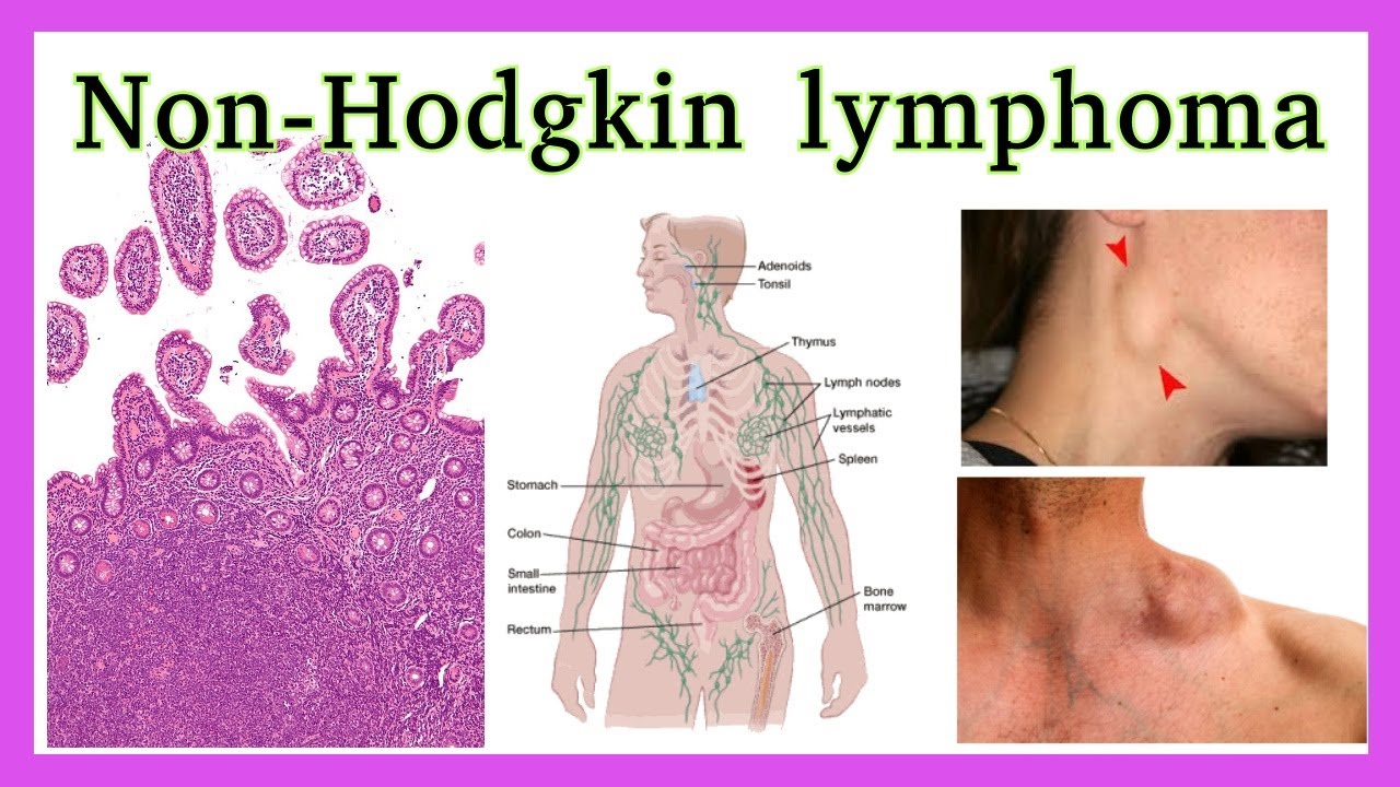 Non-Hodgkin Lymphoma