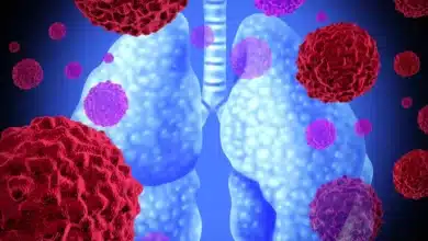 Non-Small Cell Lung Cancer vs Small Cell Lung Cancer