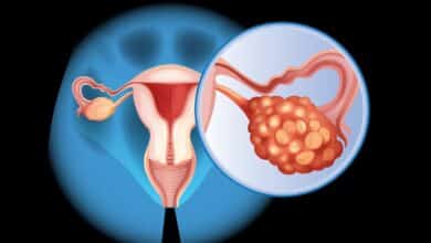 Ovarian Cancer