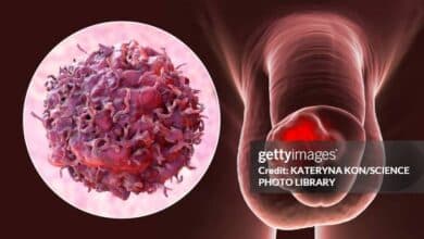 Penile Cancer