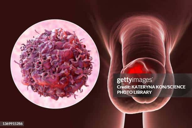 Penile Cancer