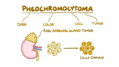 Pheochromocytoma