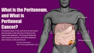 Primary Peritoneal Cancer