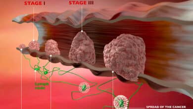 Rectal Cancer vs Colon Cancer