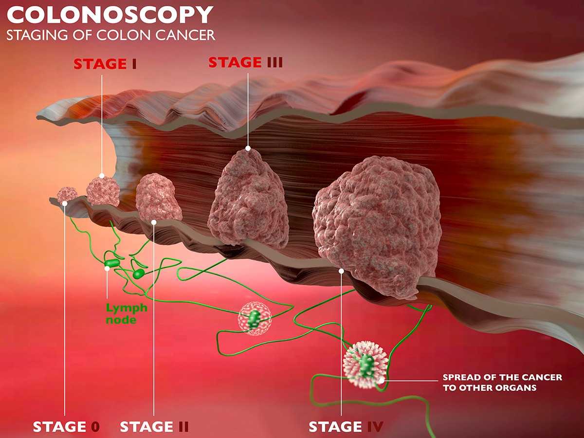 Rectal Cancer vs Colon Cancer