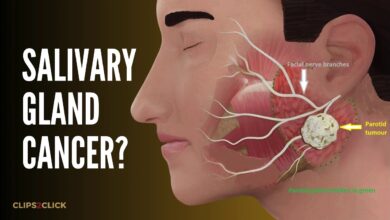 Salivary Gland Cancer