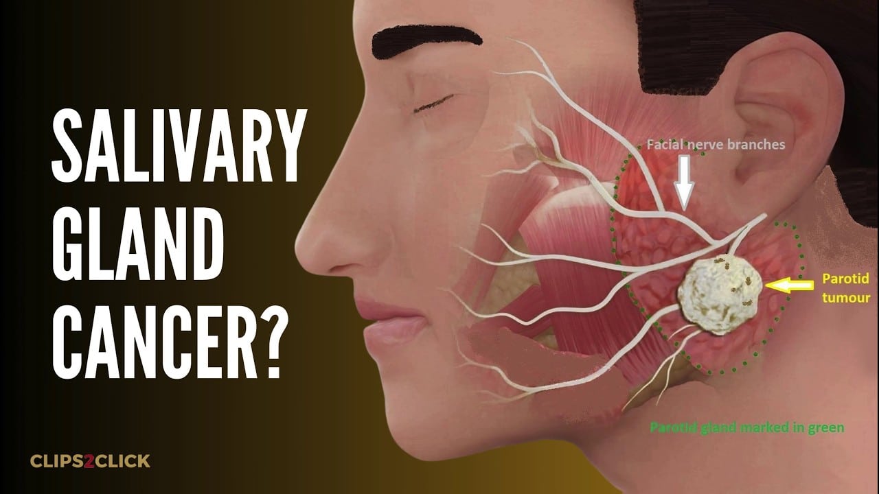 Salivary Gland Cancer