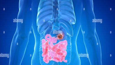 Small Intestine Cancer