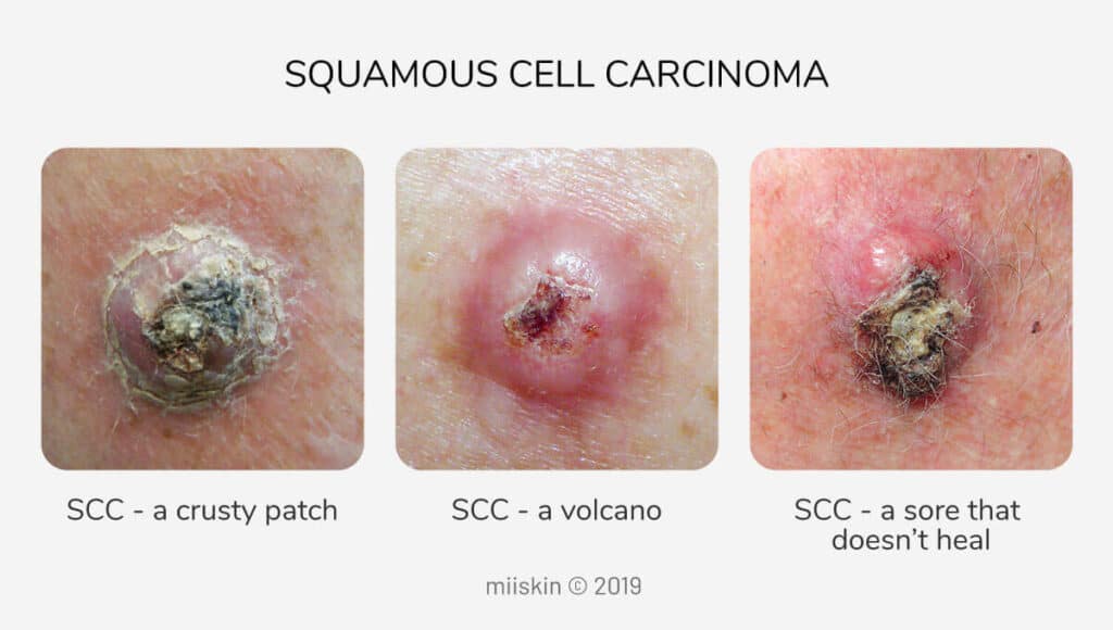 Squamous Cell Carcinoma of the Skin: When a Wound Won't Heal - Observer ...