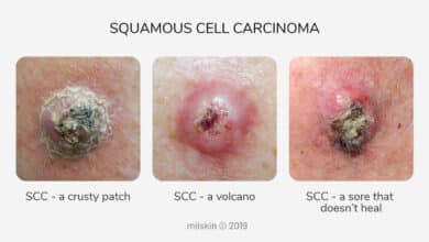 Squamous Cell Carcinoma of the Skin