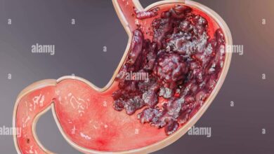 Stomach (Gastric) Cancer