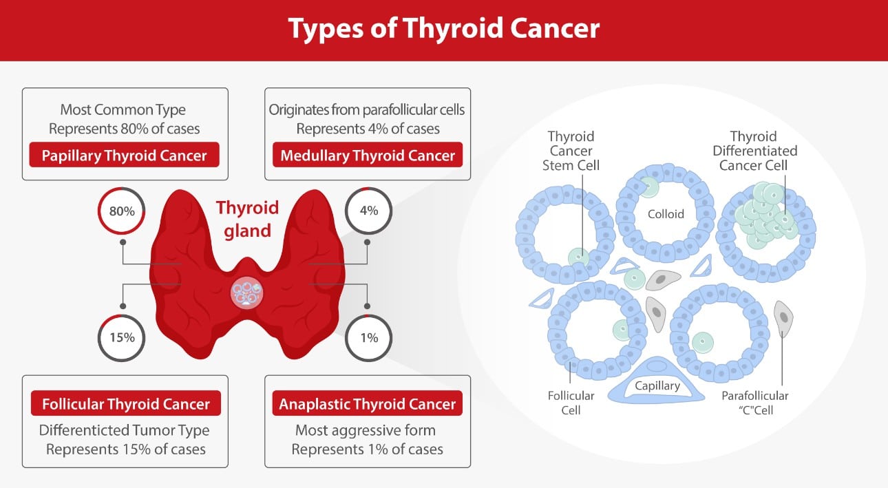 Thyroid Cancer