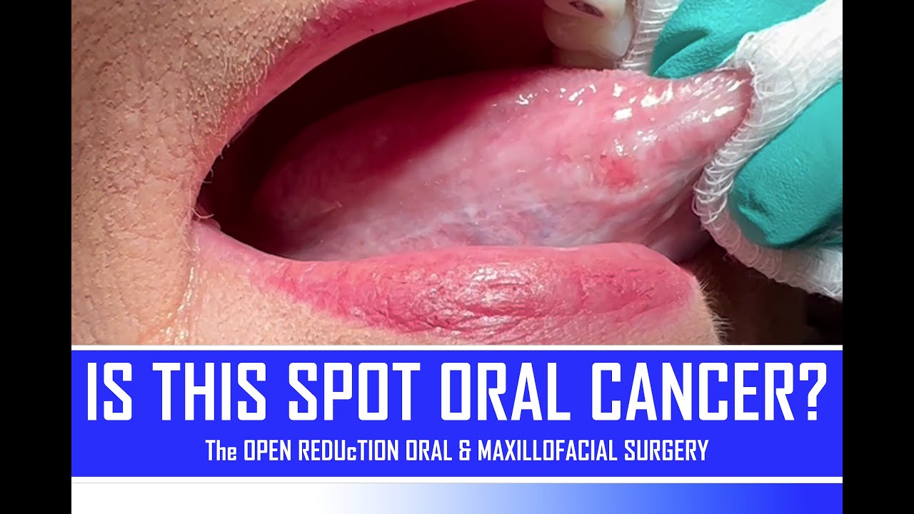 Tongue Cancer
