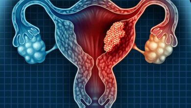 Uterine (Endometrial) Cancer