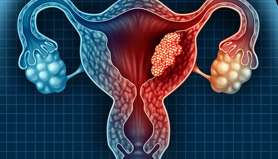 Uterine (Endometrial) Cancer