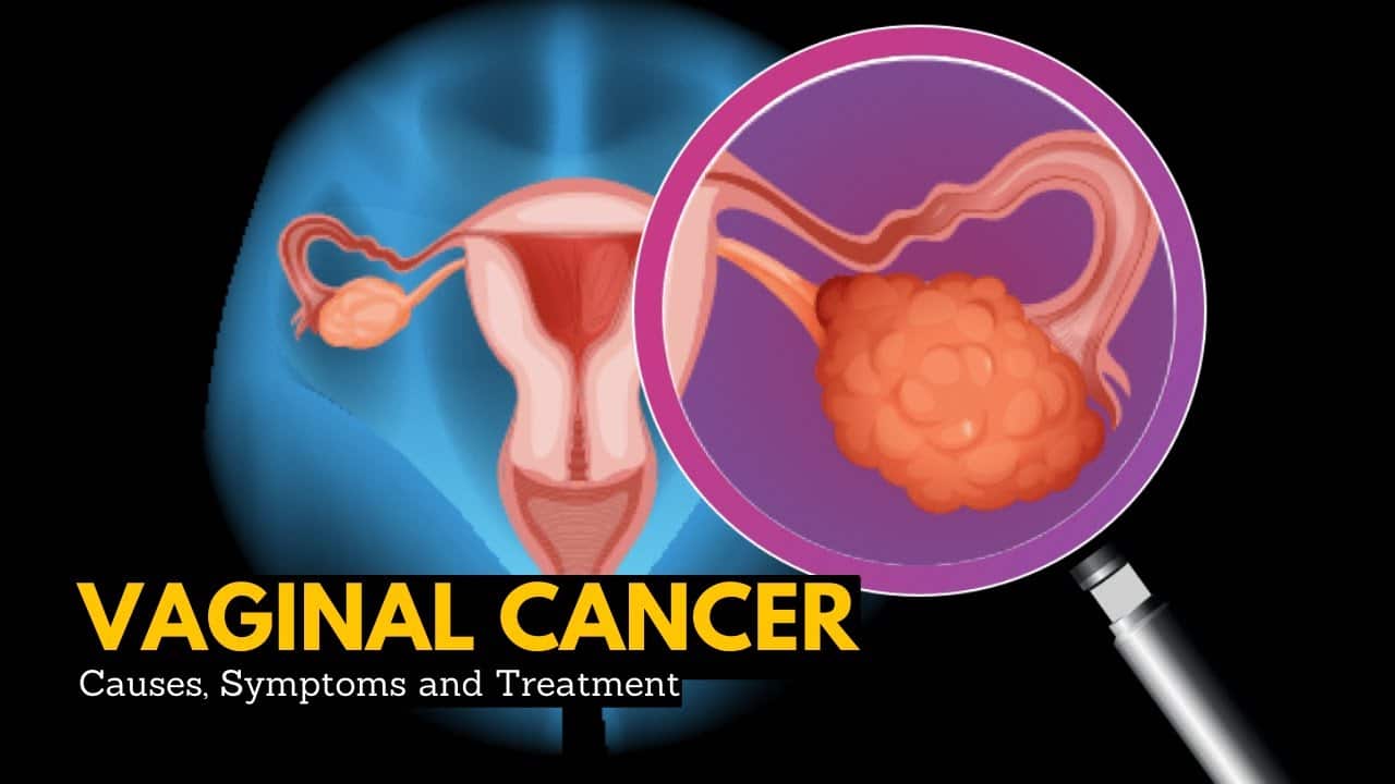 Vaginal Cancer
