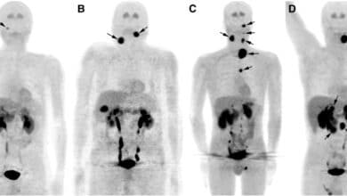 Paraganglioma