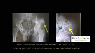 Chondrosarcoma