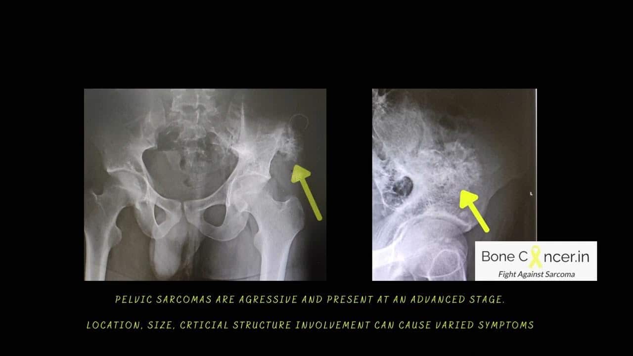 Chondrosarcoma