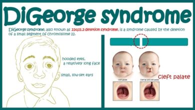 22q11.2 Deletion Syndrome (DiGeorge)