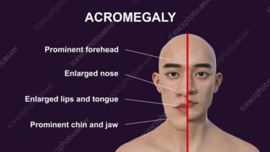 Acromegaly
