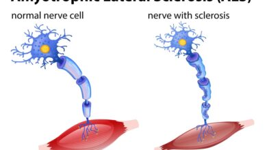 Amyotrophic Lateral Sclerosis (ALS)