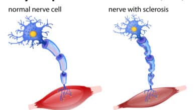 Amyotrophic Lateral Sclerosis (ALS)