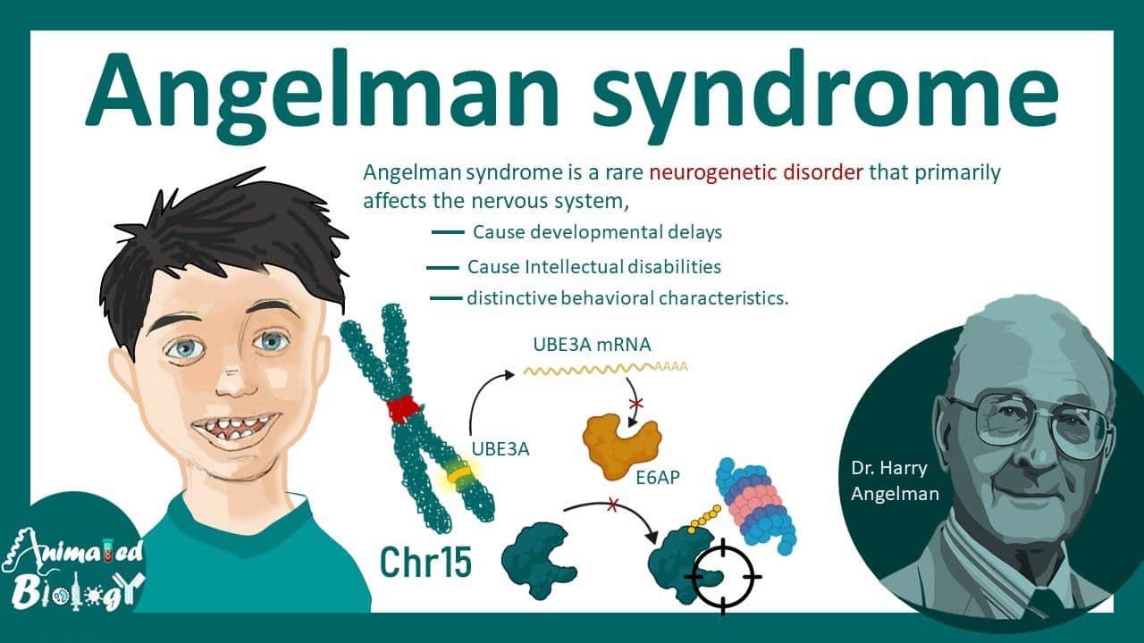 Angelman Syndrome