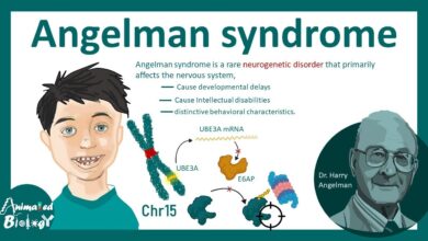 Angelman Syndrome