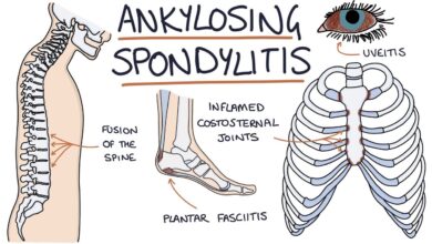 Ankylosing Spondylitis