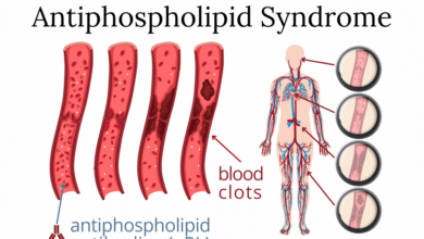 Antiphospholipid Syndrome