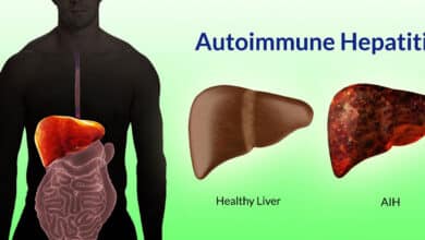 Autoimmune Hepatitis