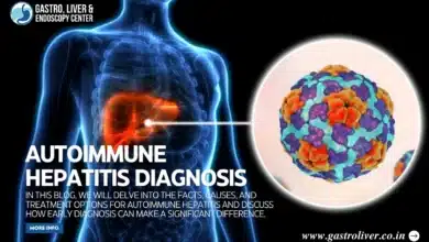 Autoimmune Hepatitis
