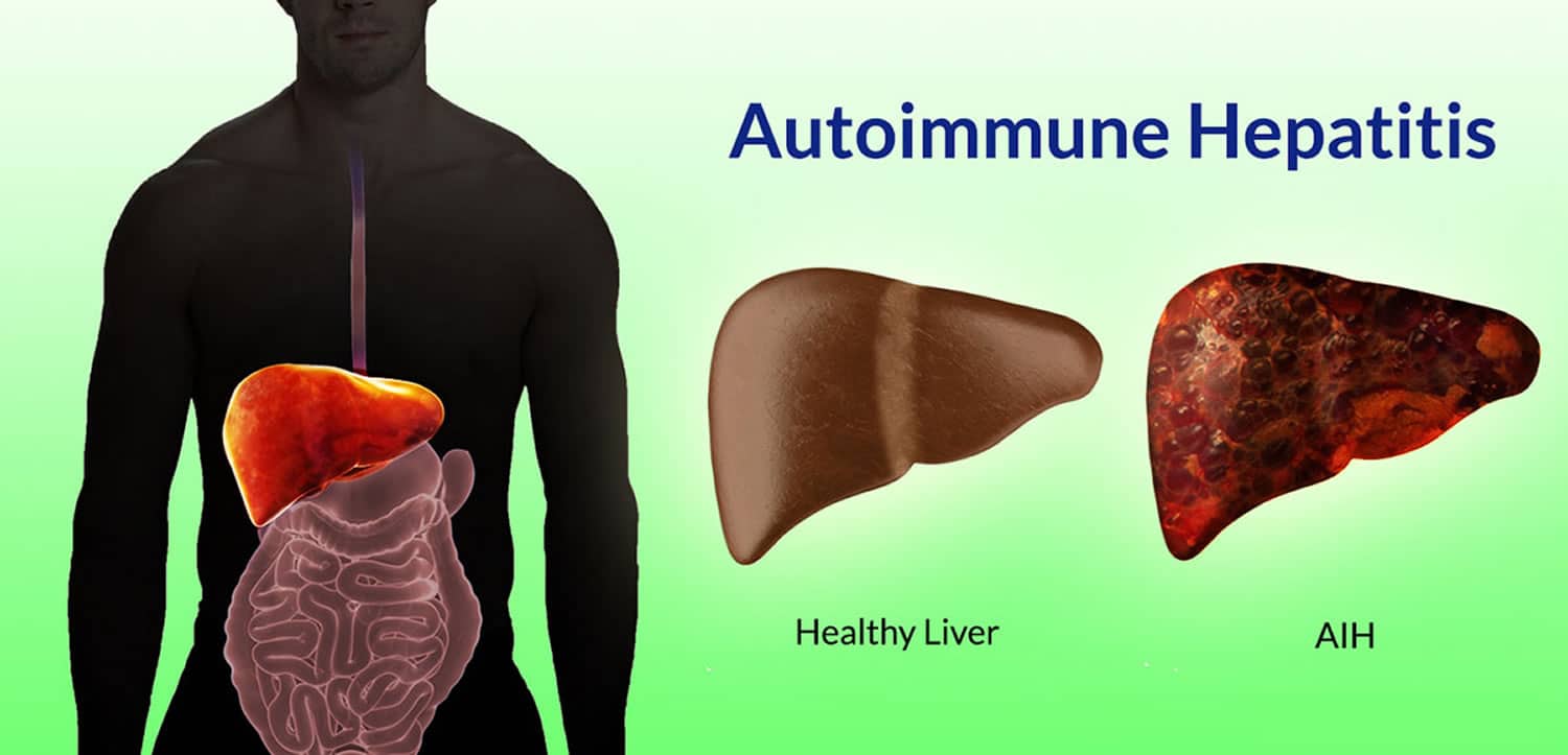 Autoimmune Hepatitis