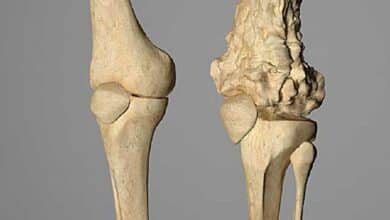 Bone Cancer (Osteosarcoma):