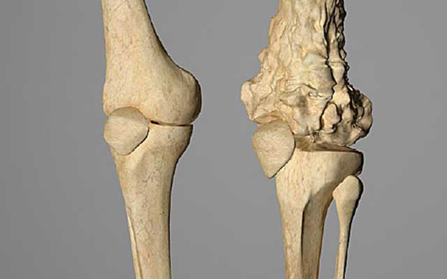 Bone Cancer (Osteosarcoma):