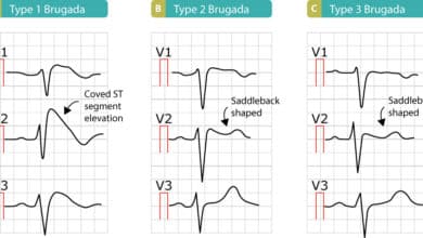 Brugada Syndrome