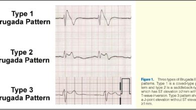 Brugada Syndrome