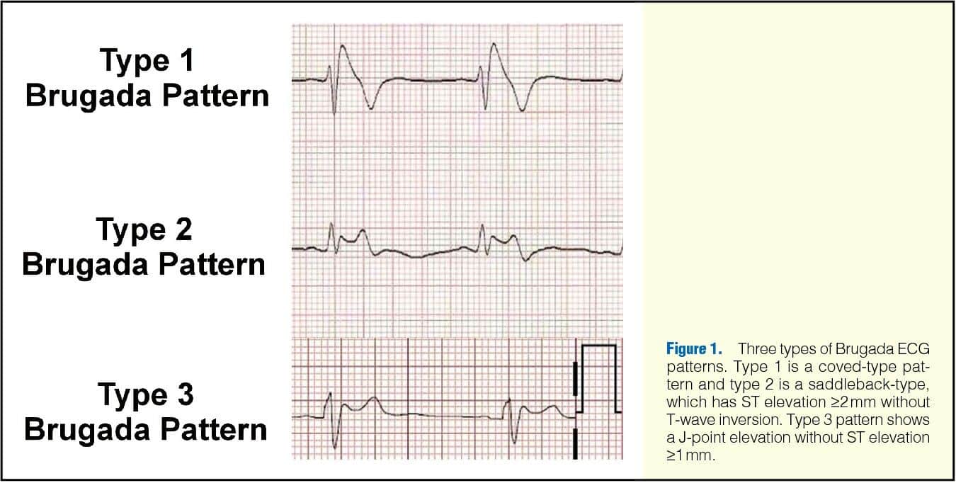 Brugada Syndrome
