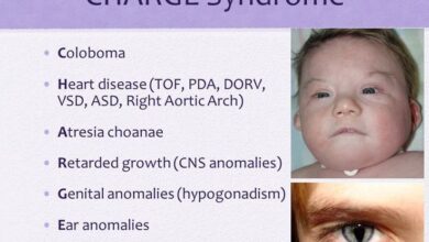 CHARGE Syndrome