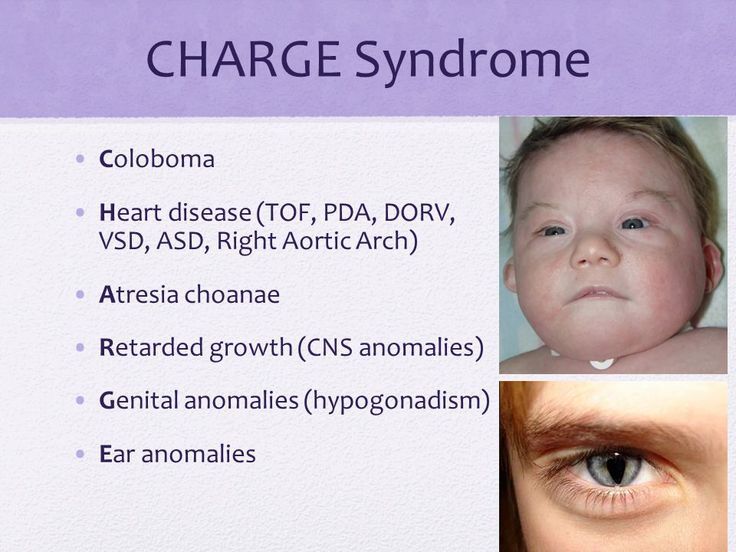 CHARGE Syndrome