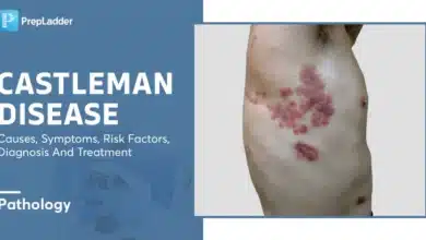 Castleman Disease