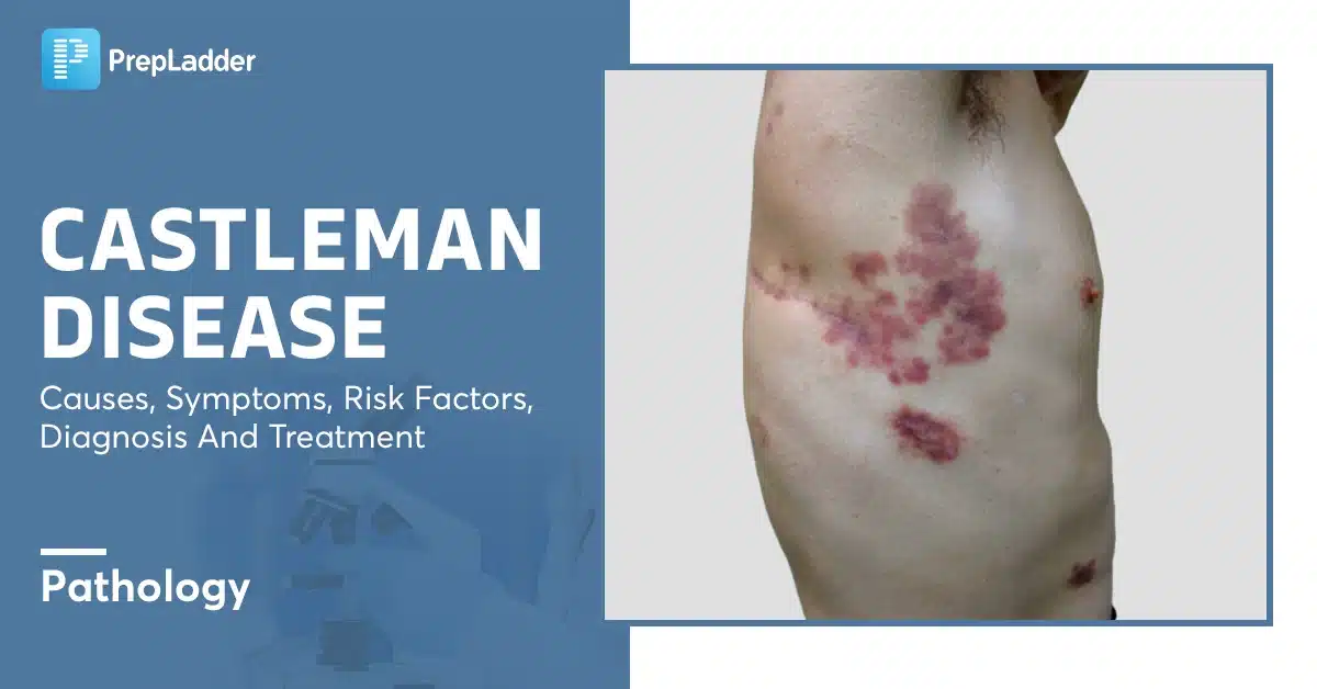 Castleman Disease: A Rare Lymph Node Disorder That Mimics Lymphoma ...