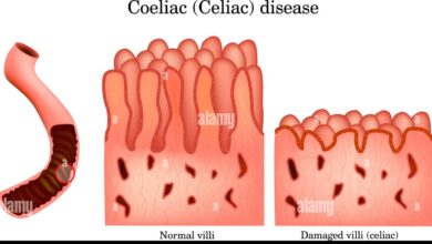 Celiac Disease