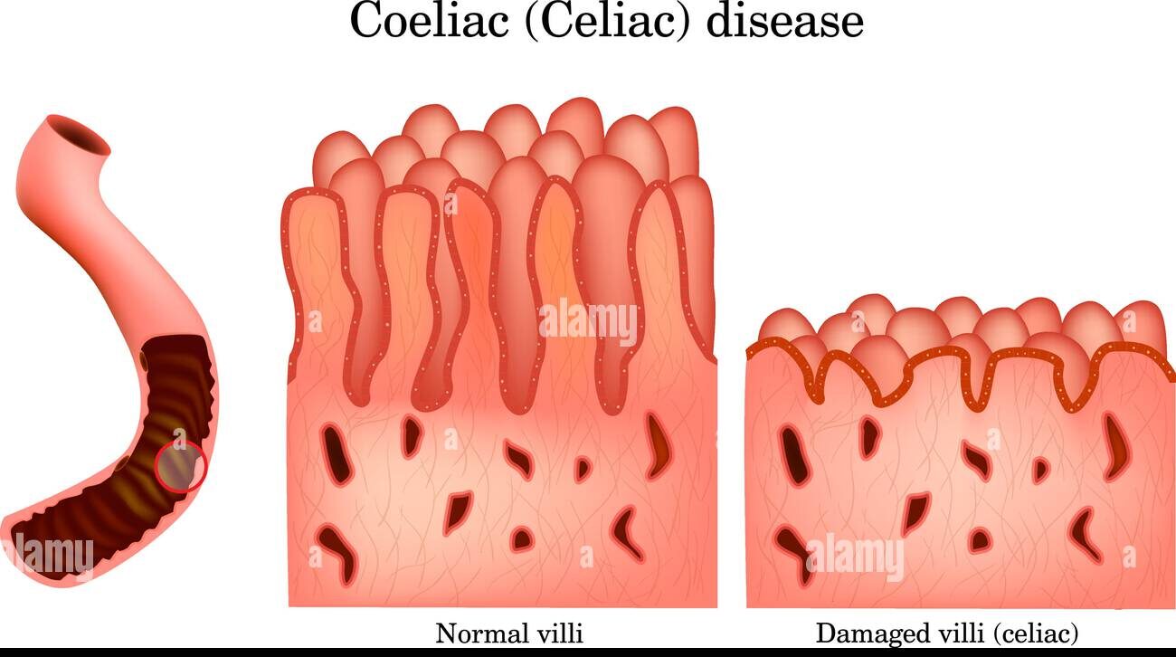 Celiac Disease