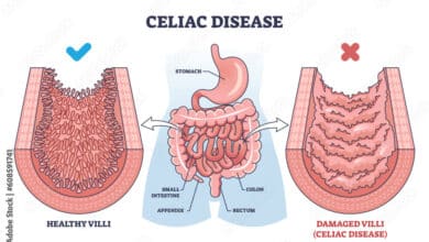 Celiac Disease