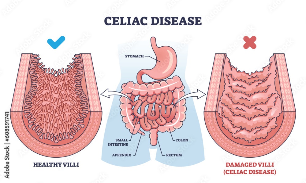 Celiac Disease