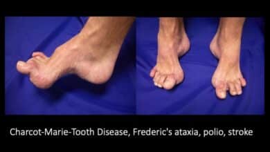 Charcot-Marie-Tooth Disease