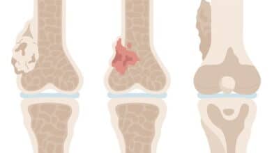 Chondrosarcoma: The Bone Cancer