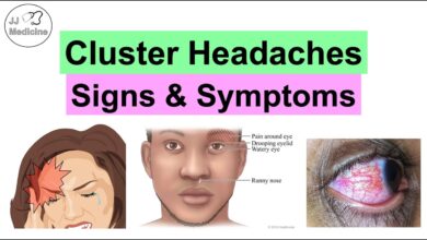 Cluster Headaches